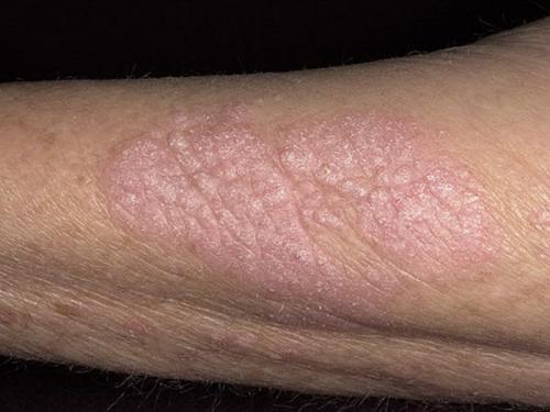 Как вывести грибок в ванной на потолке народными средствами. Чем опасен грибок на стенах